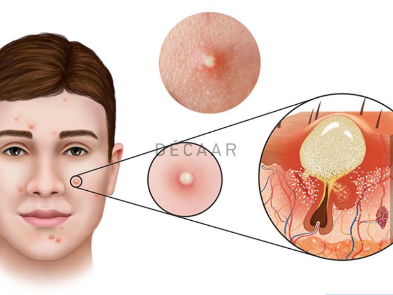 nguyên nhân mụn trứng cá bọc